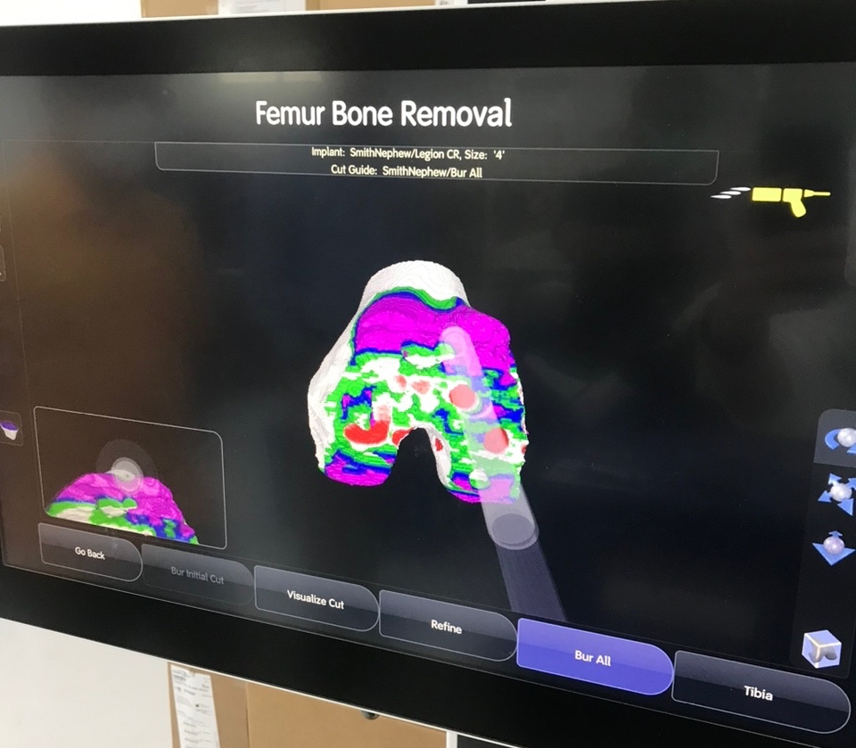 Robotic total knee replacement Kuala Lumpur Malaysia by Dr Sanjiv Rampal Consultant Orthopaedic Surgeon, Petaling Jaya.