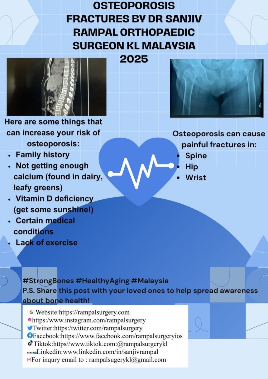 Osteoporosis Fractures by Dr Sanjiv Rampal Orthopaedic Surgeon KL Malaysia 2025